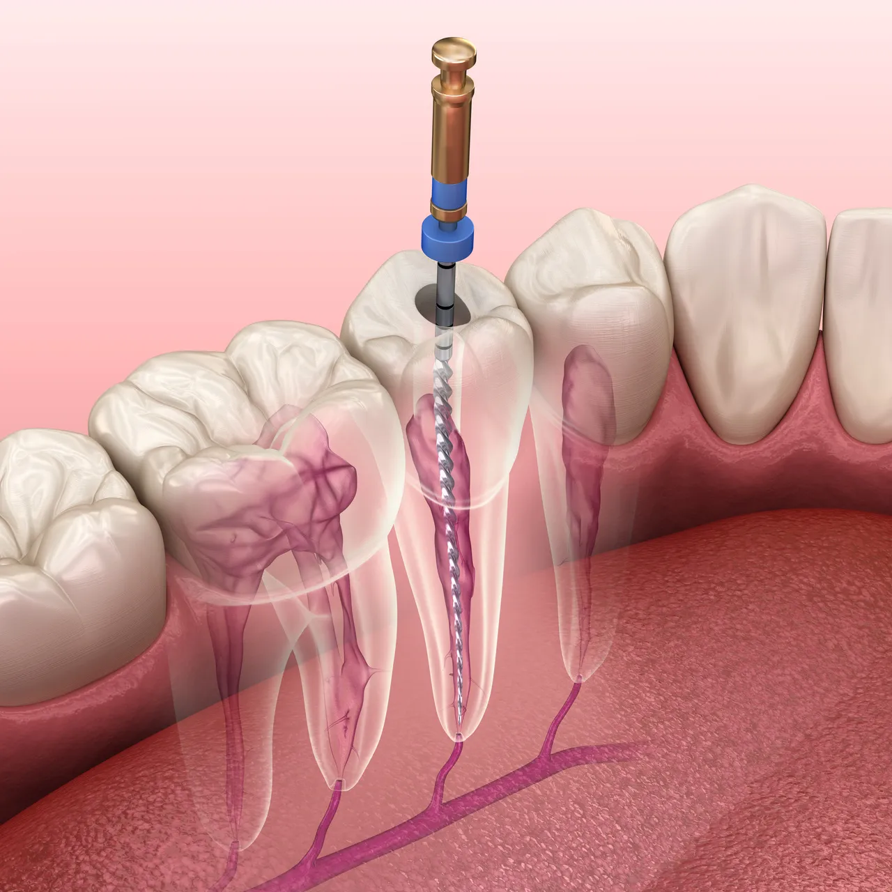 Zahnarzt Benda - Zahnarztpraxis - Ablauf der endodontischen Wurzelkanalbehandlung. Medizinisch genaue 3D-Zahnillustration.